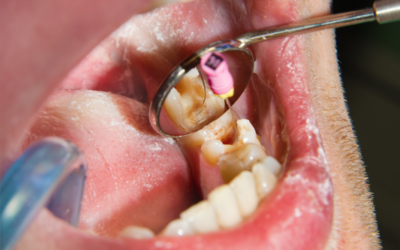 Root canal in Tijuana: It is Safe the Treatment?