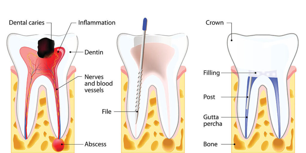 endodontics in Tijuana