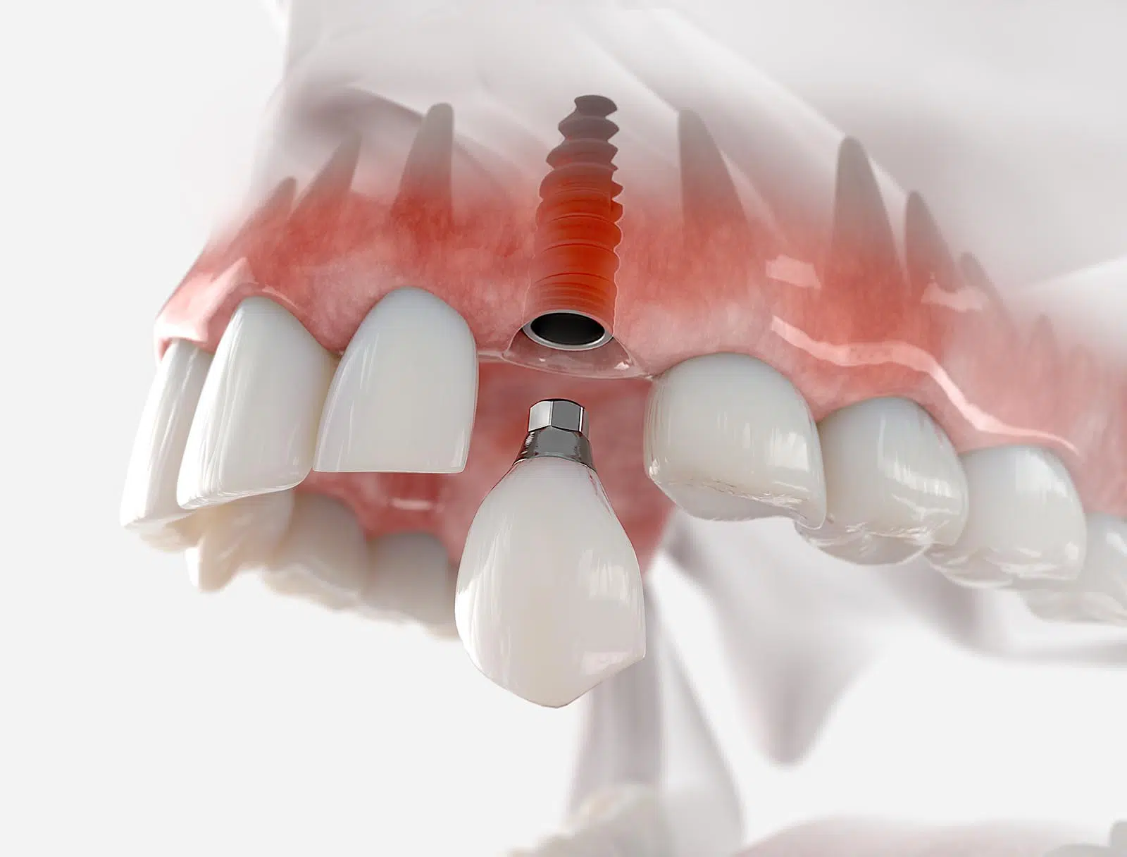 Broken-tooth-implant