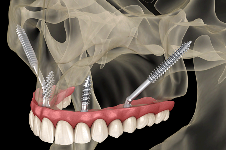 Implantes-dentales-en-tijuana