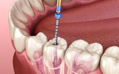 How long does a Root Canal take?