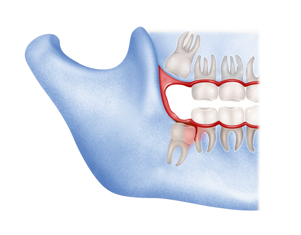 Muela del juicio infectada