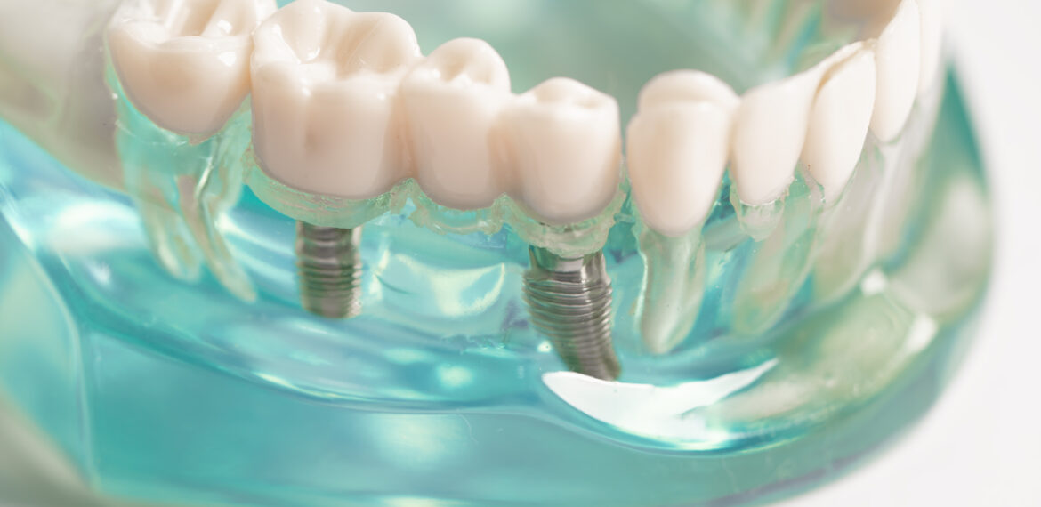 Dental-implants-Tijuana