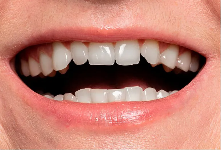 teeth-whitening-after